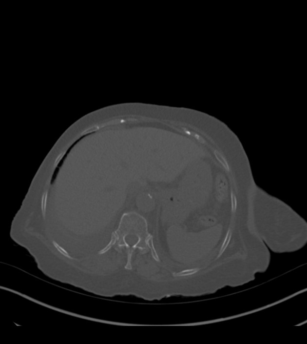 Amiodarone deposition in the liver (Radiopaedia 77587-89780 Axial bone window 74).jpg