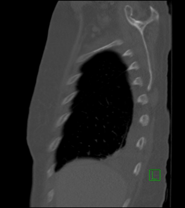Amiodarone deposition in the liver (Radiopaedia 77587-89780 Sagittal bone window 82).jpg