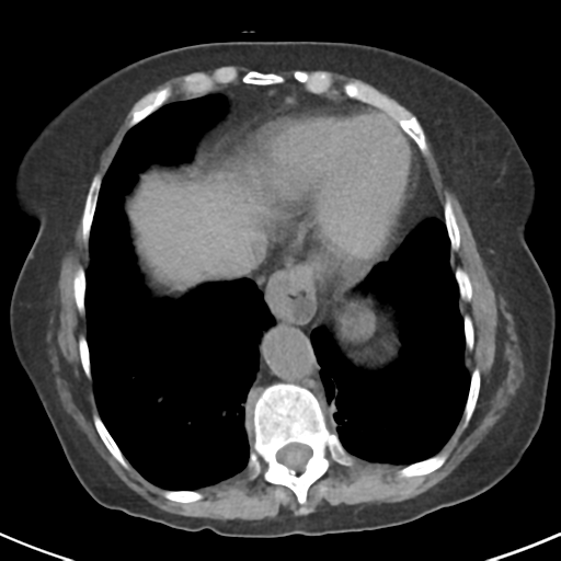 File:Ampullary adenocarcinoma (Radiopaedia 34013-35237 Axial non-contrast 5).png
