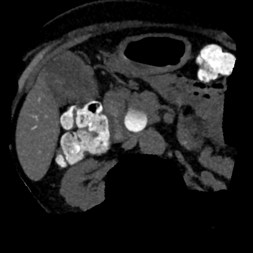 Ampullary adenocarcinoma (Radiopaedia 34013-35241 AXIAL MIPS 3-1.5 64).png