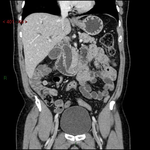 Ampullary carcinoma (Radiopaedia 56396-63056 E 48).jpg