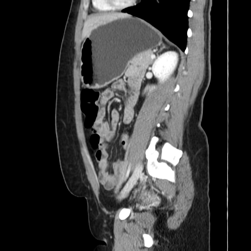 Ampullary tumor (Radiopaedia 22787-22816 D 36).jpg