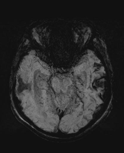 File:Amyloid angiopathy with inflammation (Radiopaedia 30360-31002 Axial SWI MIP 15).jpg