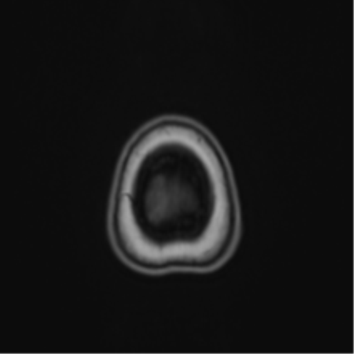 Anaplastic astroblastoma (Radiopaedia 55666-62194 Axial T1 72).png