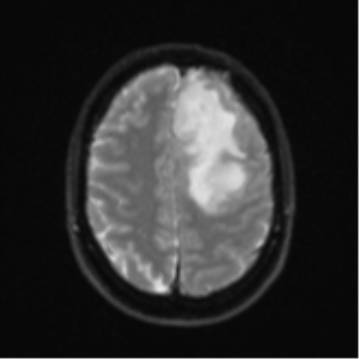 Anaplastic astrocytoma (Radiopaedia 57768-64731 Axial DWI 22).png