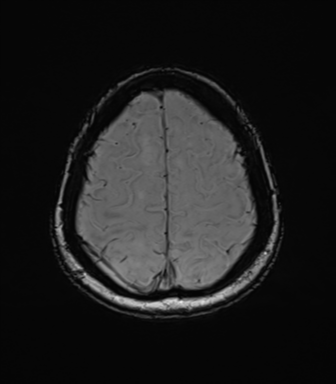 Anaplastic astrocytoma (Radiopaedia 86943-103160 Axial SWI 74).png