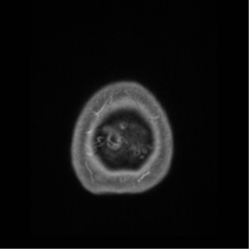 Anaplastic astrocytoma IDH wild-type (pseudoprogression) (Radiopaedia 42209-45276 Axial T1 C+ 145).png