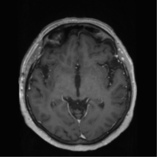 File:Anaplastic astrocytoma IDH wild-type (pseudoprogression) (Radiopaedia 42209-45278 Axial T1 C+ 75).png