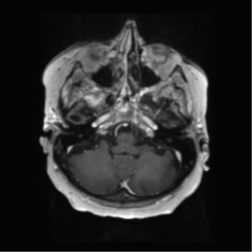 File:Anaplastic astrocytoma IDH wild-type (pseudoprogression) (Radiopaedia 42209-45279 Axial T1 C+ 33).png