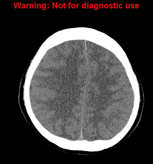 File:Anaplastic ganglioglioma (Radiopaedia 44921-48815 Axial non-contrast 20).jpg