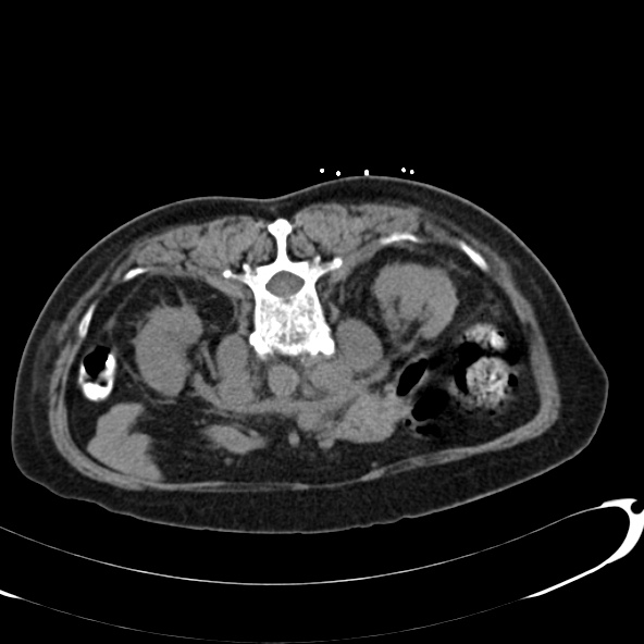 File:Anaplastic lymphoma - with CT biopsy (Radiopaedia 21643-21602 Axial non-contrast 26).jpg