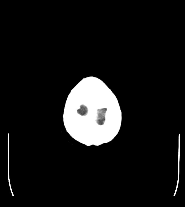 Anaplastic oligodendroglioma (Radiopaedia 79571-92753 Axial non-contrast 51).jpg