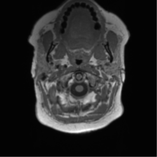 Anaplastic oligodendroglioma (Radiopaedia 83500-98599 Axial T1 3).png