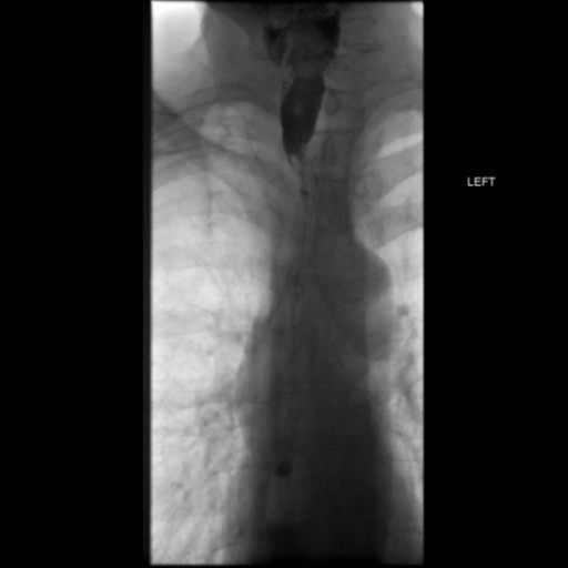 File:Anastomotic stricture post Ivor Lewis esophagectomy (Radiopaedia 47937-52715 B 6).png