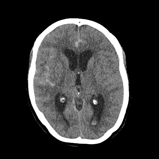 Aneursym related subarachnoid hemorrhage with hydrocephalus (Radiopaedia 45105-49083 Axial non-contrast 24).jpg