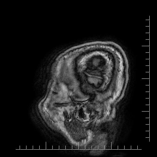 File:Aneurysm of posterior communicating artery (Radiopaedia 20188-20163 Sagittal T1 68).jpg