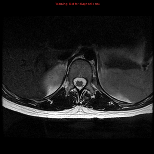 File:Aneurysmal bone cyst (Radiopaedia 9419-10103 Axial T2 19).jpg