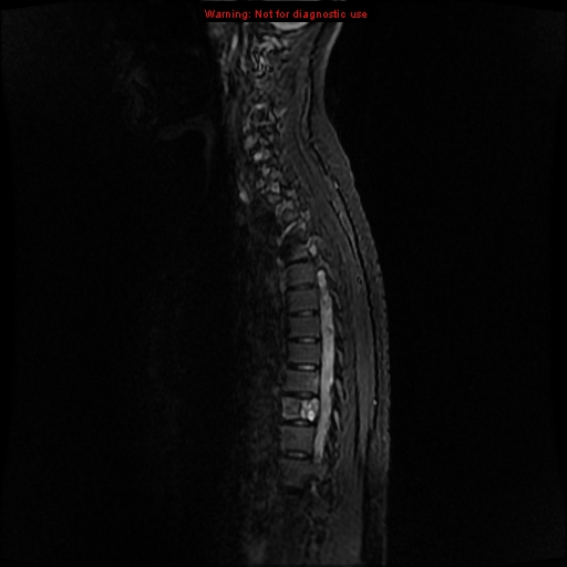 File:Aneurysmal bone cyst (Radiopaedia 9419-10103 Sagittal T2 2).jpg