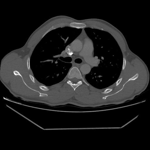 Aneurysmal bone cyst - rib (Radiopaedia 82167-96220 Axial bone window 113).jpg