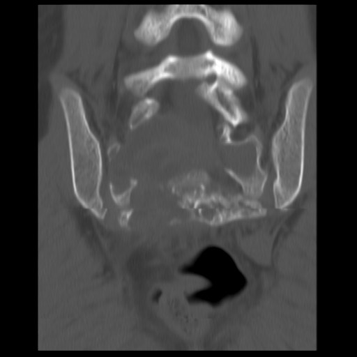 File:Aneurysmal bone cyst - sacrum (Radiopaedia 65190-74195 Coronal bone window 8).jpg