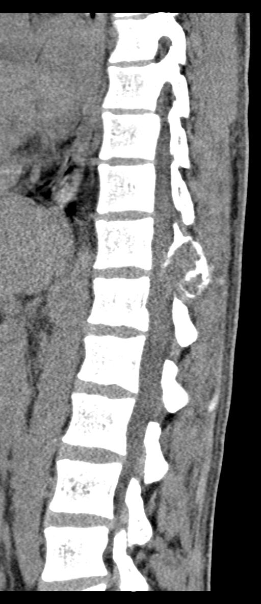 Aneurysmal bone cyst T11 (Radiopaedia 29294-29721 E 36).jpg