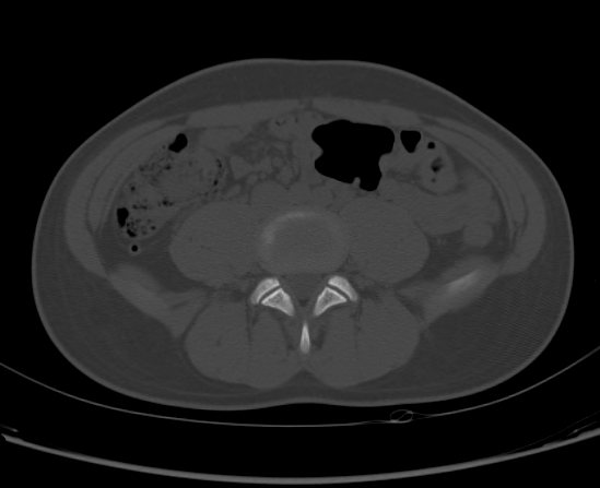 File:Aneurysmal bone cyst of ischium (Radiopaedia 25957-26094 Axial bone window 6).png
