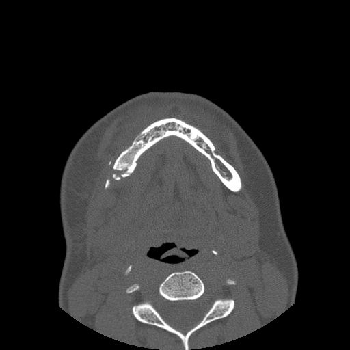 Aneurysmal bone cyst of the mandible (Radiopaedia 43280-46823 Axial bone window 31).jpg