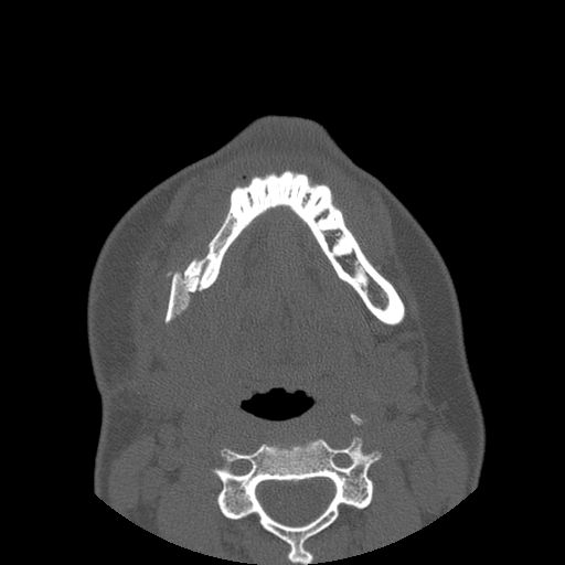 Aneurysmal bone cyst of the mandible (Radiopaedia 43280-46823 Axial bone window 40).jpg