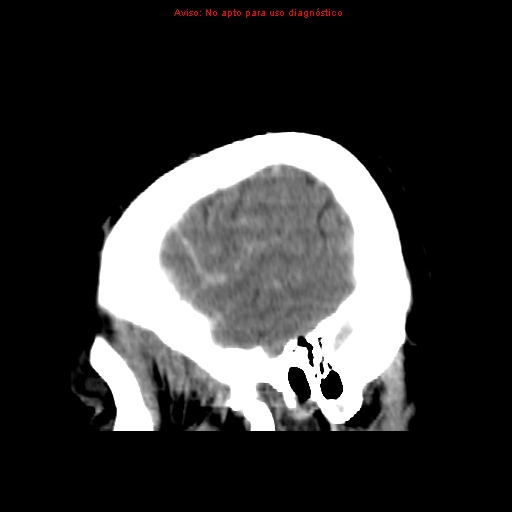 File:Aneurysmal subarachnoid hemorrhage (Radiopaedia 24740-24997 non-contrast 5).jpg