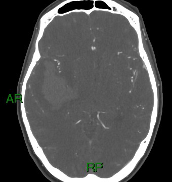 File:Aneurysmal subarachnoid hemorrhage with intra-axial extension (Radiopaedia 84371-99732 A 24).jpg