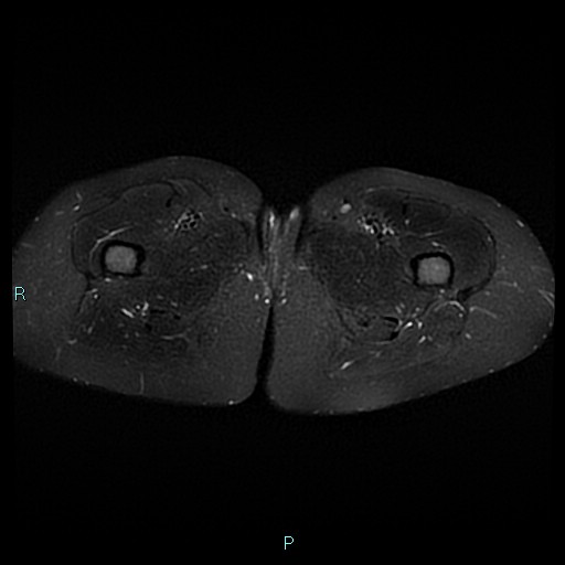 Angioleiomyoma (Radiopaedia 85442-101078 Axial STIR 30).jpg