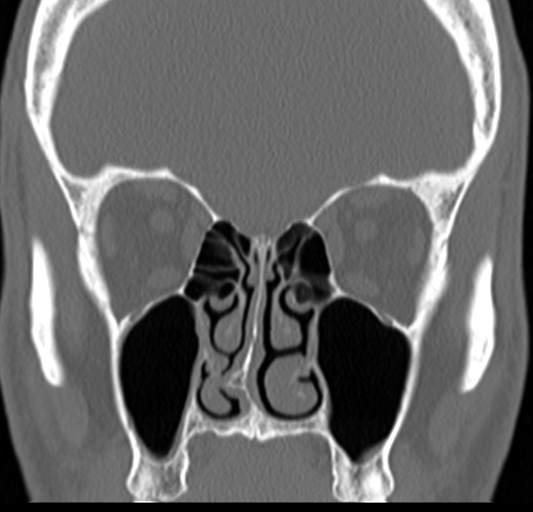 Angular epidermoid cyst (Radiopaedia 46908-51439 Coronal bone window 31).png
