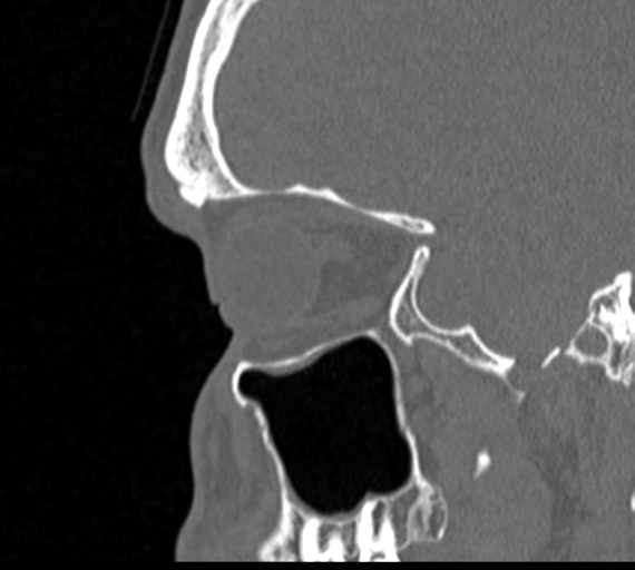 Angular epidermoid cyst (Radiopaedia 46908-51439 Sagittal bone window 18).png