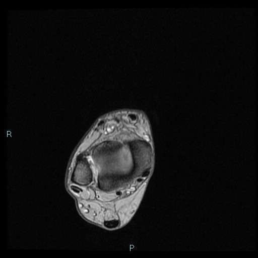 Ankle ganglion cyst (Radiopaedia 62809-71162 Axial Gradient Echo 69).jpg