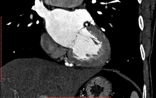 Anomalous left coronary artery from the pulmonary artery (ALCAPA) (Radiopaedia 70148-80181 B 169).jpg