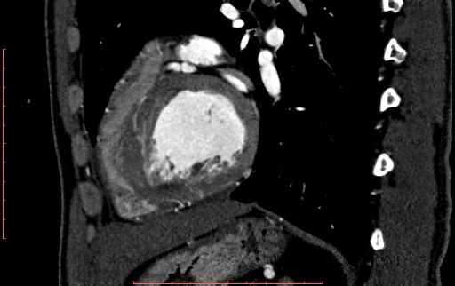 File:Anomalous left coronary artery from the pulmonary artery (ALCAPA) (Radiopaedia 70148-80181 C 174).jpg