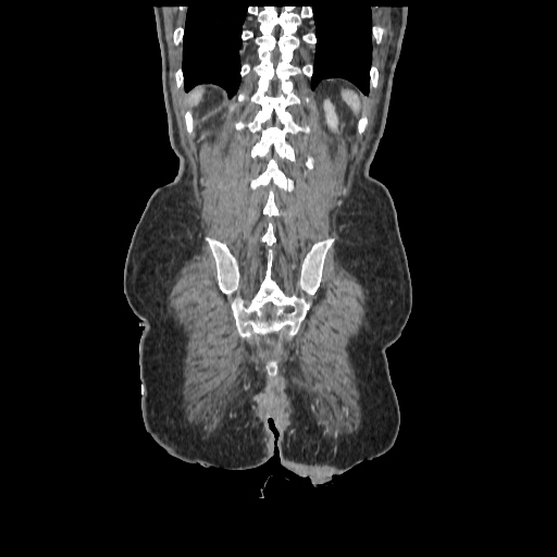 Anorectal carcinoma (Radiopaedia 44413-48064 B 78).jpg
