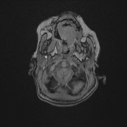Anoxic brain injury (Radiopaedia 79165-92139 Axial MRA 17).jpg
