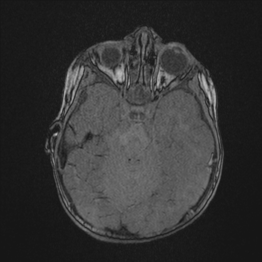 Anoxic brain injury (Radiopaedia 79165-92139 Axial MRA 74).jpg