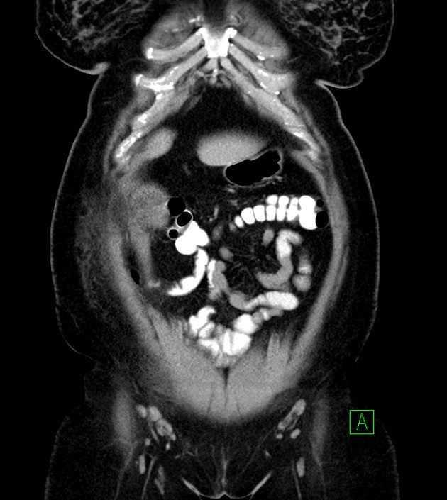 Anterior abdominal wall CSF pseudocyst (CSFoma) (Radiopaedia 79453-92571 B 16).jpg