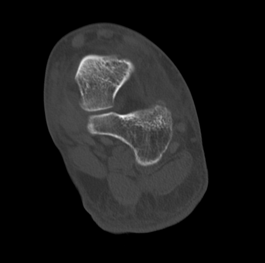 Anterior calcaneal process fracture (Radiopaedia 47384-51989 Coronal bone window 56).png