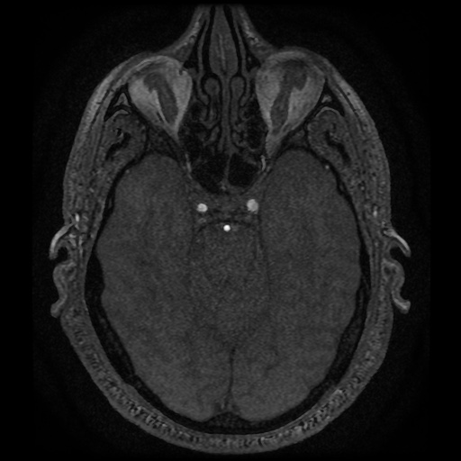 Anterior cerebral artery infarction (Radiopaedia 46794-51323 Axial MRA 55).jpg