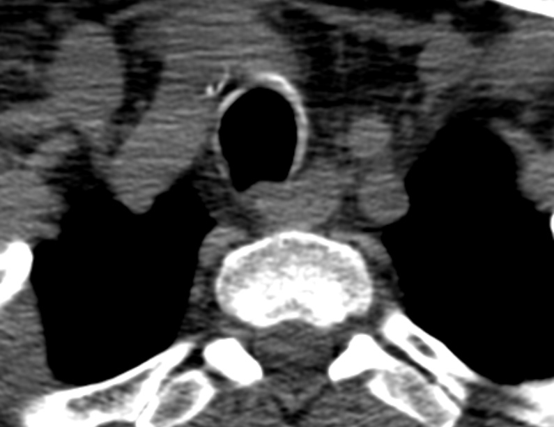 Anterior cervical postdiscectomy arthrodesis (Radiopaedia 32678-33646 Axial non-contrast 72).jpg