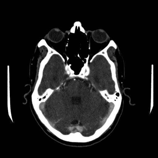 File:Anterior communicating artery aneurysm (Radiopaedia 16633-16335 A 12).jpg