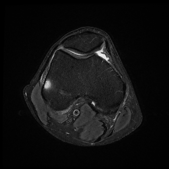 File:Anterior cruciate ligament graft tear and bucket-handle tear of medial meniscus (Radiopaedia 75867-87254 Axial PD fat sat 18).jpg