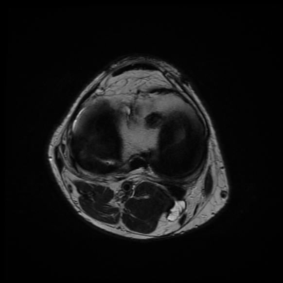 File:Anterior cruciate ligament graft tear and bucket-handle tear of medial meniscus (Radiopaedia 75867-87254 Axial T2 9).jpg