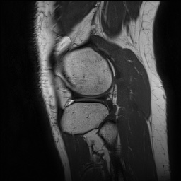 Anterior cruciate ligament rupture and posteromedial corner injury (Radiopaedia 67338-76723 Sagittal PD 135).jpg