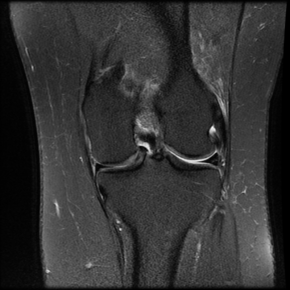 File:Anterior cruciate ligament tear, Wrisberg rip and bucket-handle tear of medial meniscus (Radiopaedia 75872-87266 Coronal PD fat sat 17).jpg