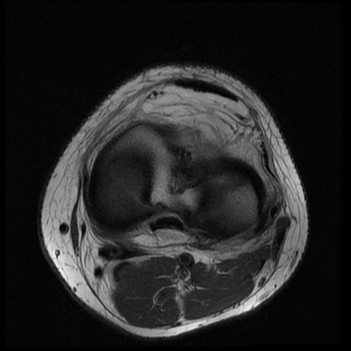 File:Anterior cruciate ligament tear (Radiopaedia 61500-69462 Axial PD 14).jpg