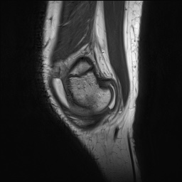 File:Anterior cruciate ligament tear - pediatric (Radiopaedia 62152-70260 Sagittal PD 28).jpg